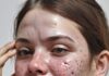 How to manage acne/pimples